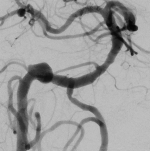 De-identified DSA image, case 49, AP view