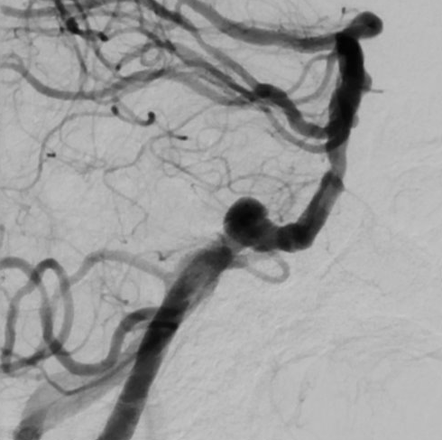 De-identified DSA image, case 49, lateral view