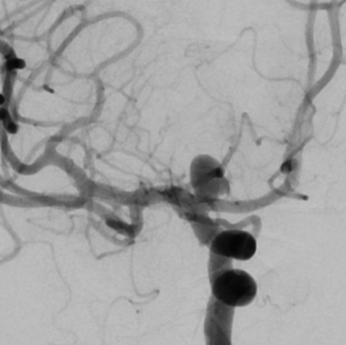 De-identified DSA image, case 61, AP view