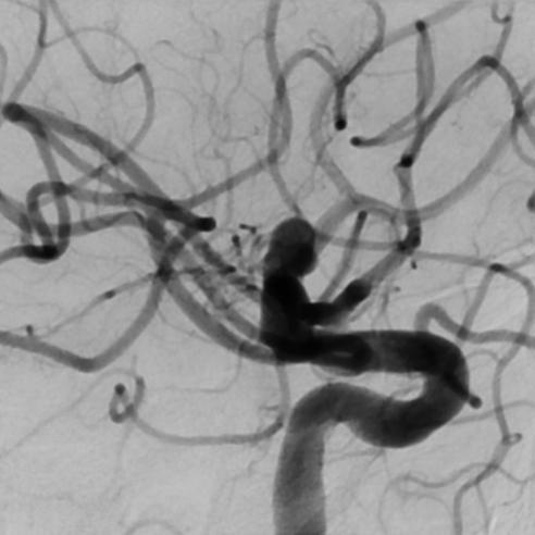 De-identified DSA image, case 61, Lateral view