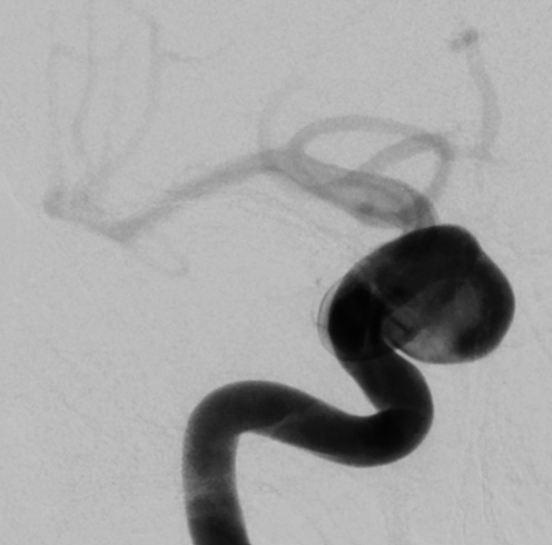 De-identified DSA image, case 95, AP view