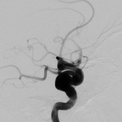 De-identified DSA image, case 95, lateral view