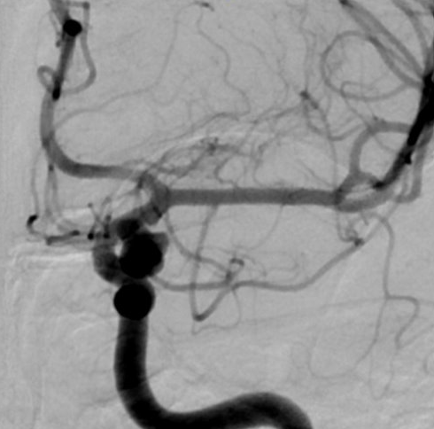 De-identified DSA image, case 96, AP view