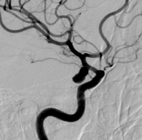 De-identified DSA image, case 96, lateral view